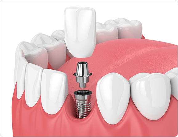 types of implants