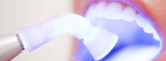 teeth whitening