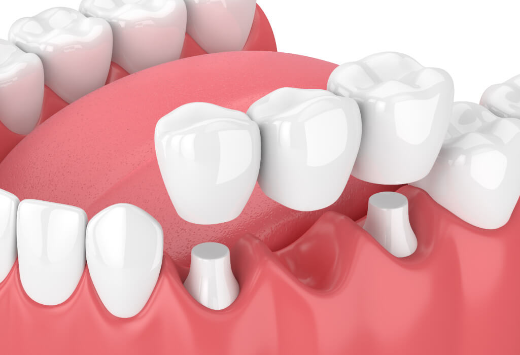 Closeup of a dental bridge to replace a missing tooth