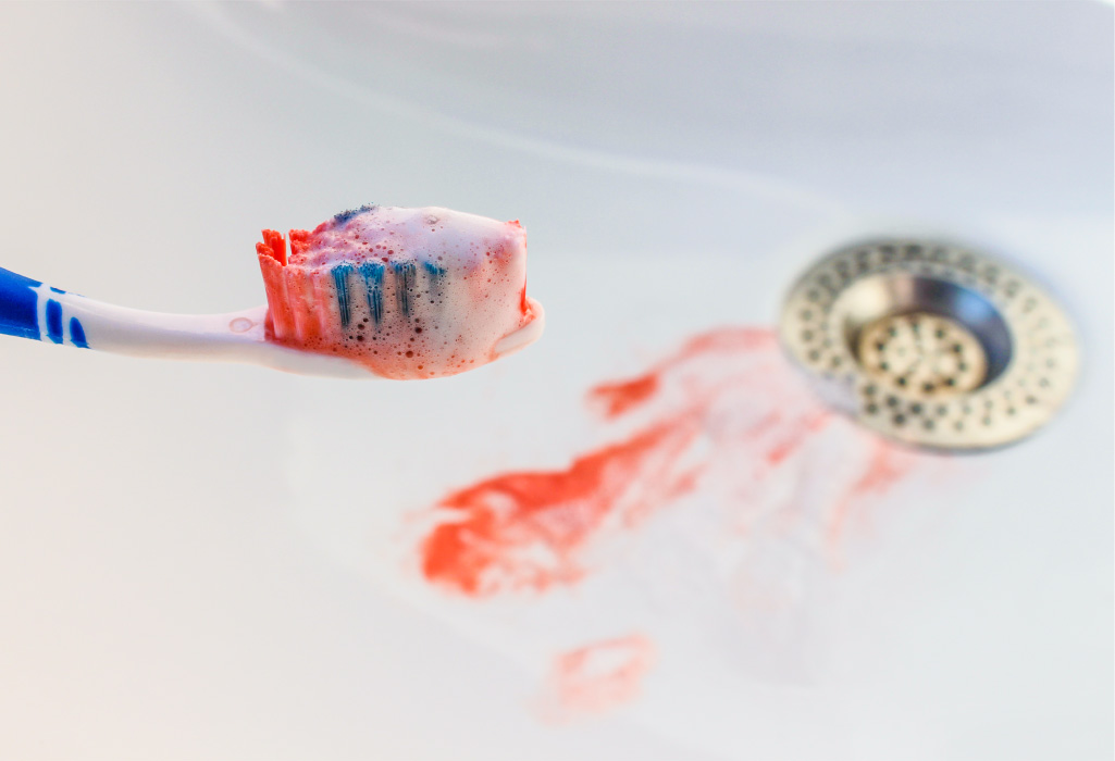 Closeup of a toothbrush with blood on it and in the sink from gum disease