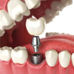 Closeup of a dental implant as a permanent tooth replacement solution