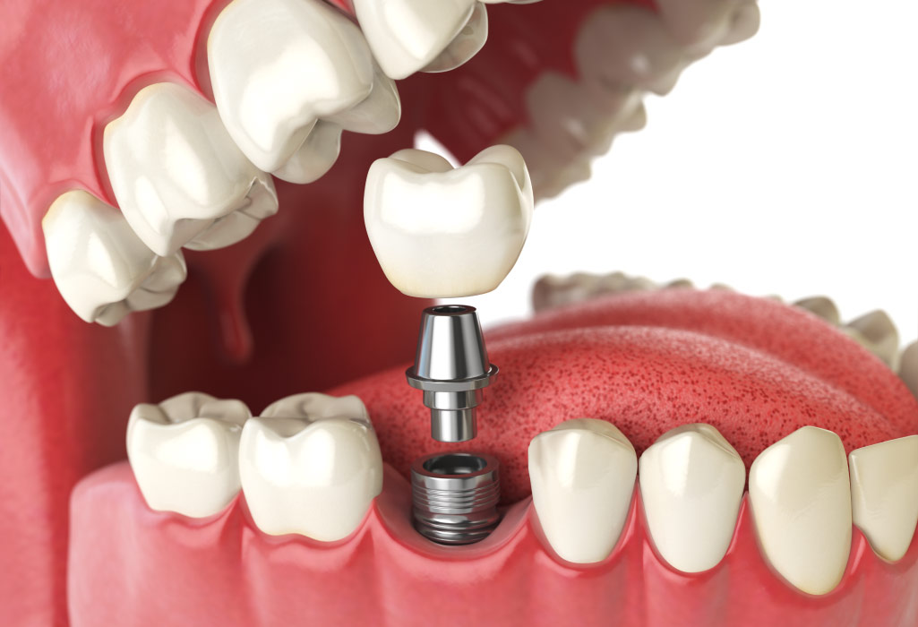 Closeup of a dental implant as a permanent tooth replacement solution