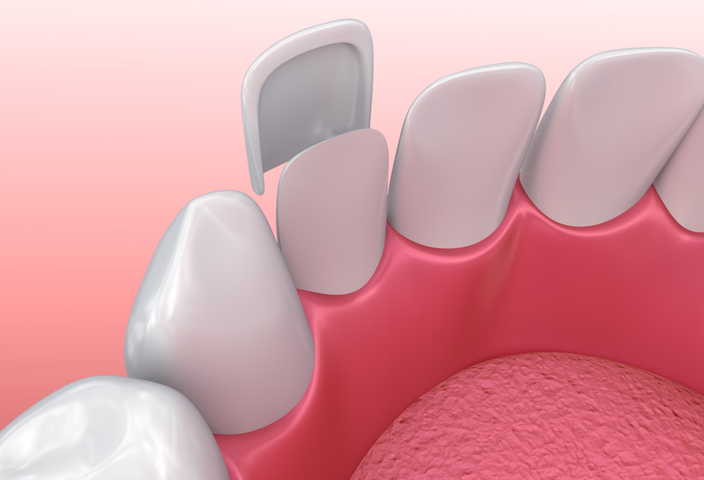 closeup of a smile with porcelain veneers attached to the front of the teeth in San Antonio, TX