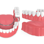 Closeup of partial dentures vs full dentures to replace teeth in San Antonio, TX