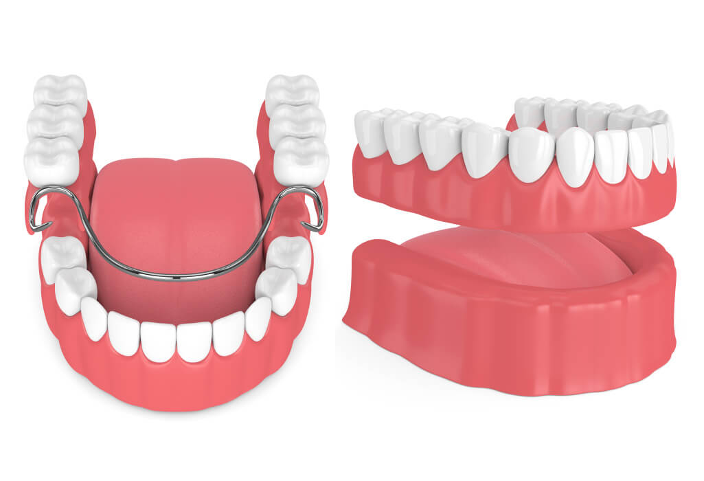 Closeup of partial dentures vs full dentures to replace teeth in San Antonio, TX