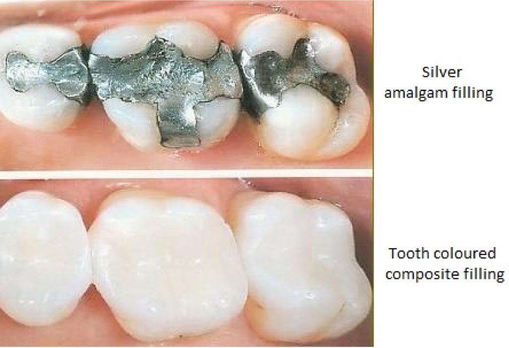 comparison between amalgam and composite fillings for teeth cavities
