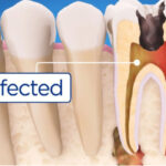 illustration of an infected tooth needing root canal therapy