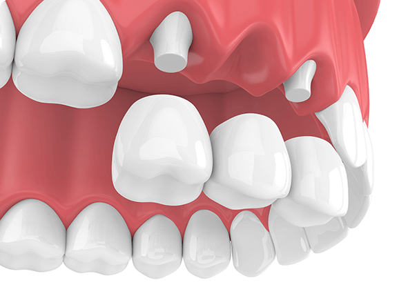 dental bridge illustration