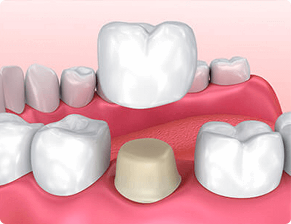 dental crown illustration