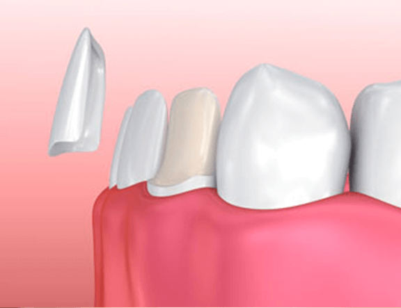 illustration of veneers