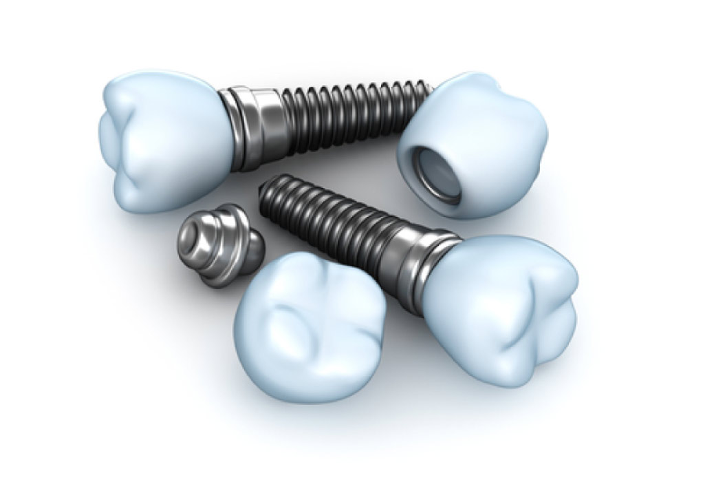 dental implant componenet