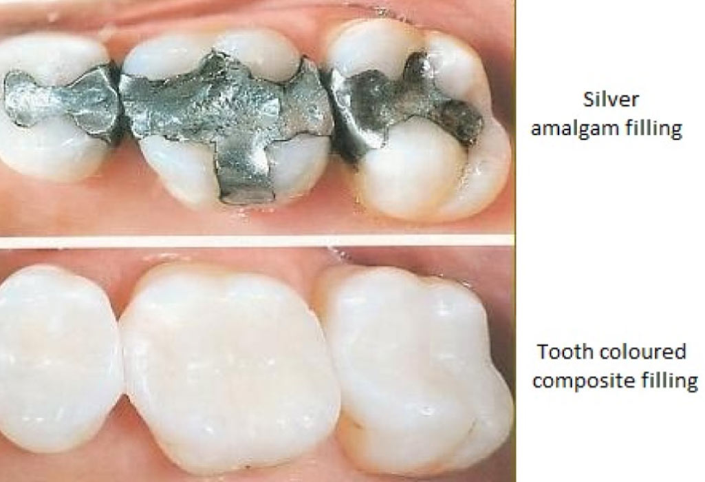 dental fillings choices compared: amalgam vs. composite