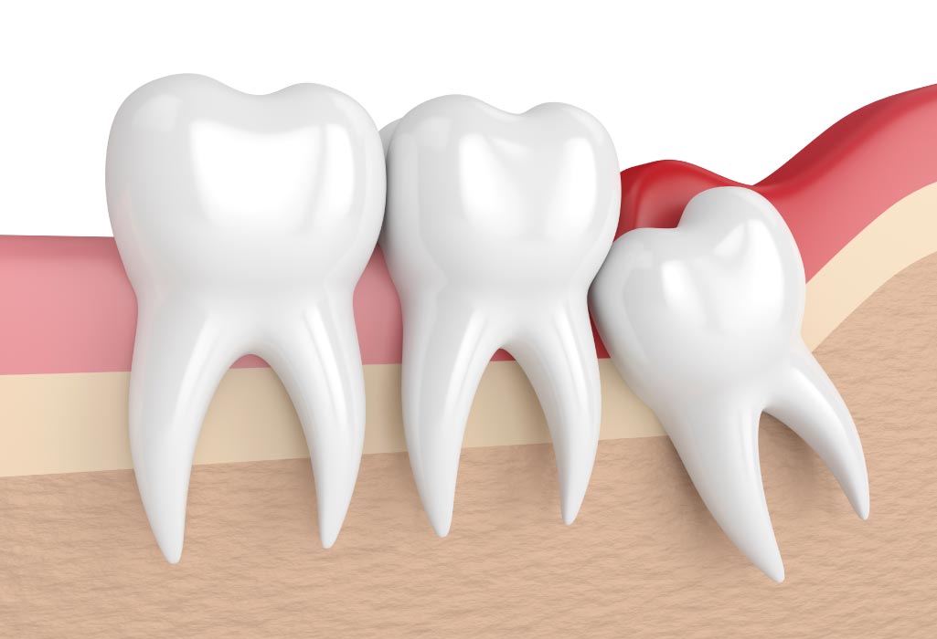 impacted tooth needing oral surgery