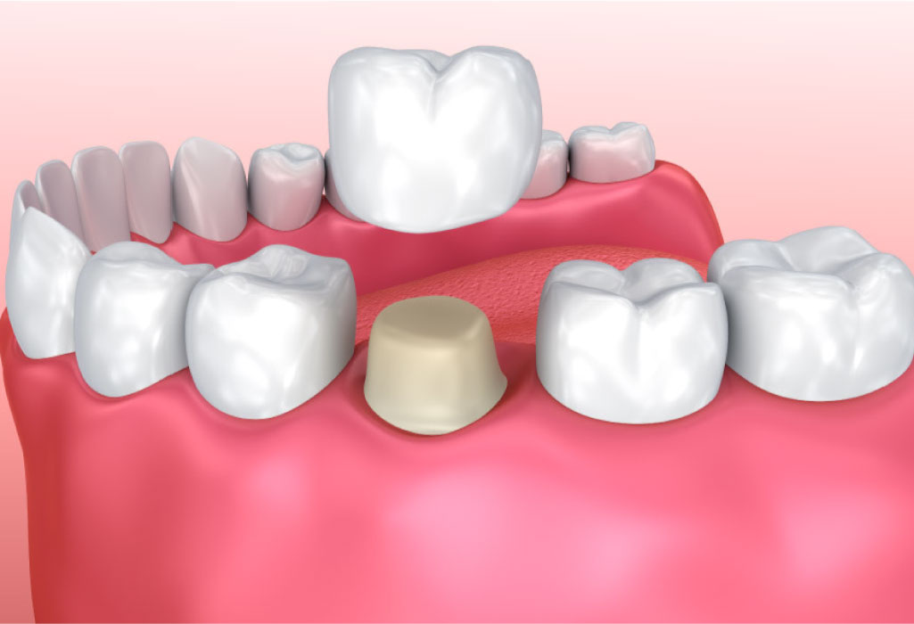 model of the dental crown process
