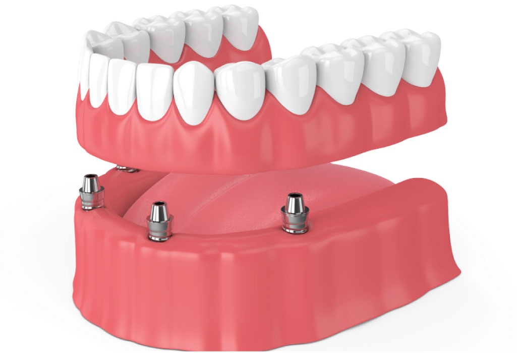 illustration of implant supported dentures