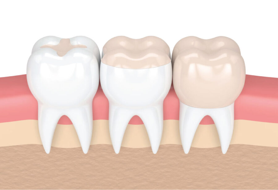 How Long Do Composite Fillings Last? Chandler Dental Center