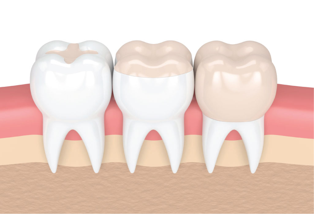 illustration of dental composite fillings