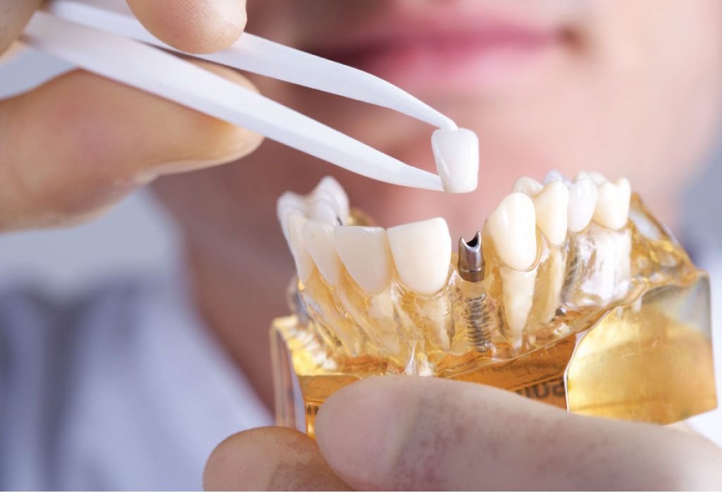 handheld dental implant model with a crown held by tweezers.