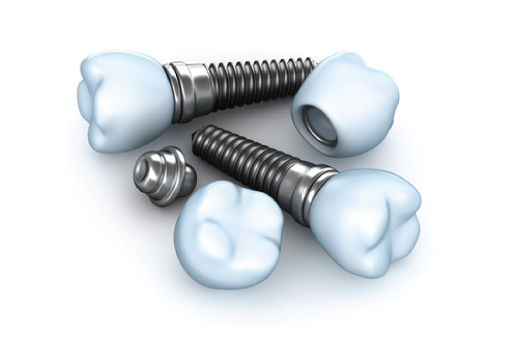 dental implant components