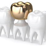 gold dental crown illustration