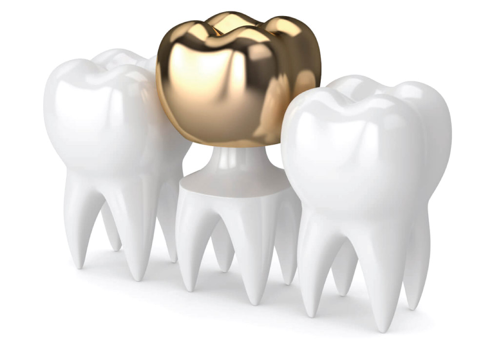 gold dental crown illustration