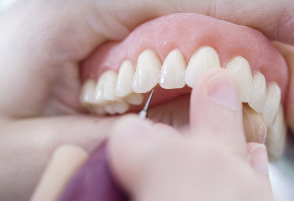 set of dentures being cleaned