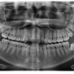 panorama x-ray of the mouth demonstrating the importance of bone preservation