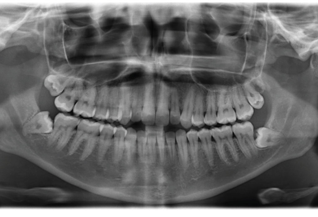 panorama x-ray of the mouth demonstrating the importance of bone preservation