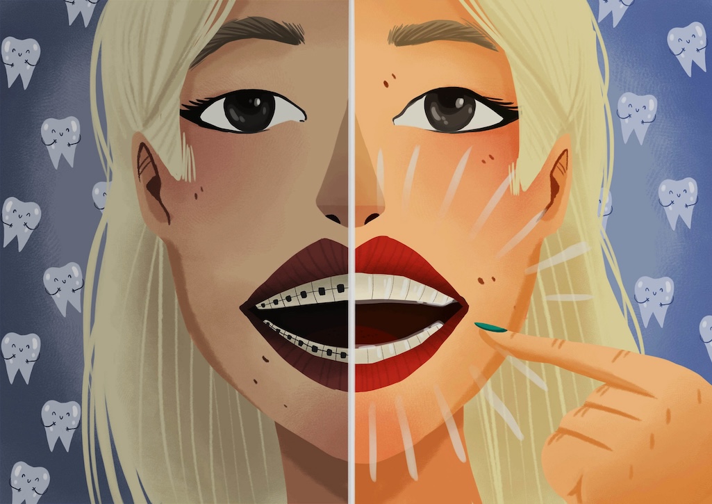 clear aligners, orthodontic treatment, discreet braces, comfortable fit, removable braces, dental aesthetics, orthodontic care, straighten teeth, invisible braces